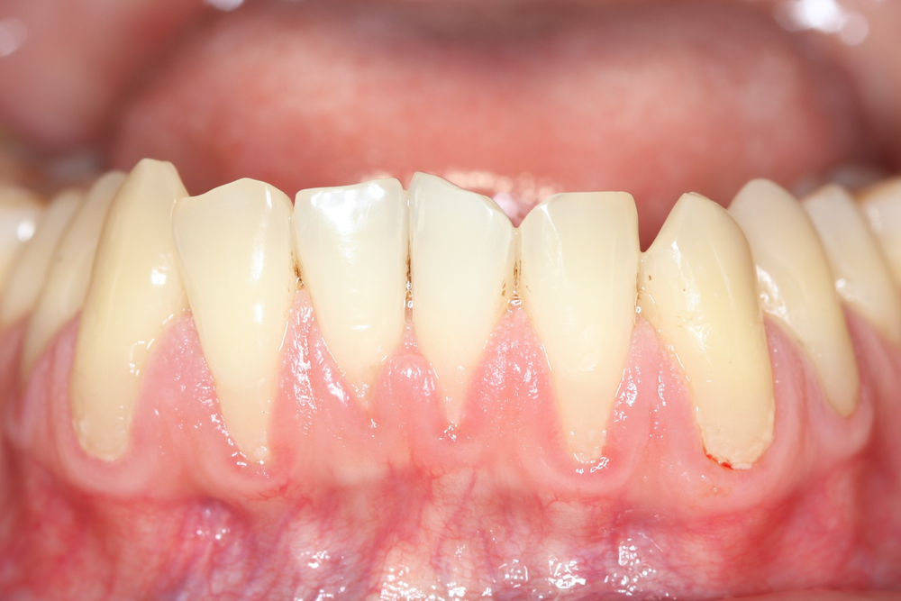 receding gums on teeth