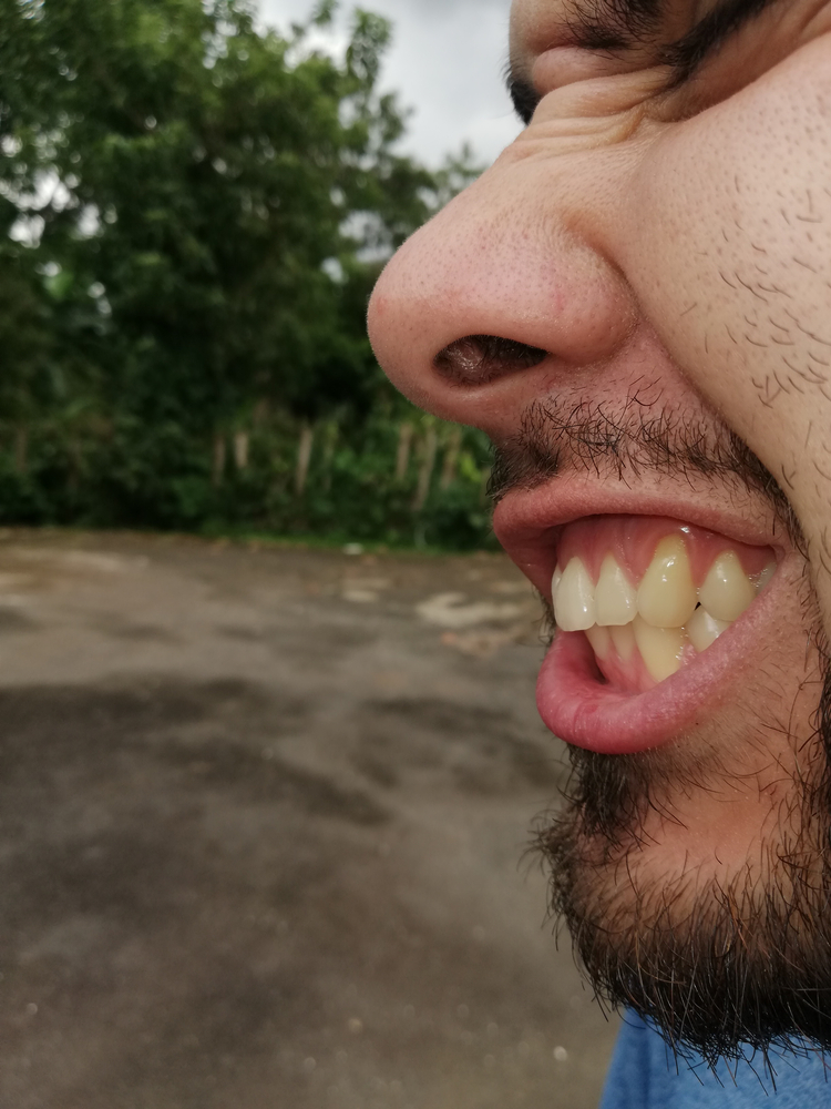 guy with receding gum on one tooth